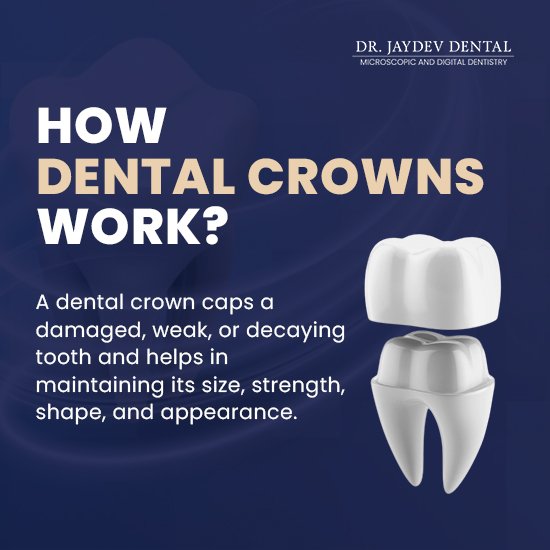 how-crowns-are-placed-over-dental-implant-placements