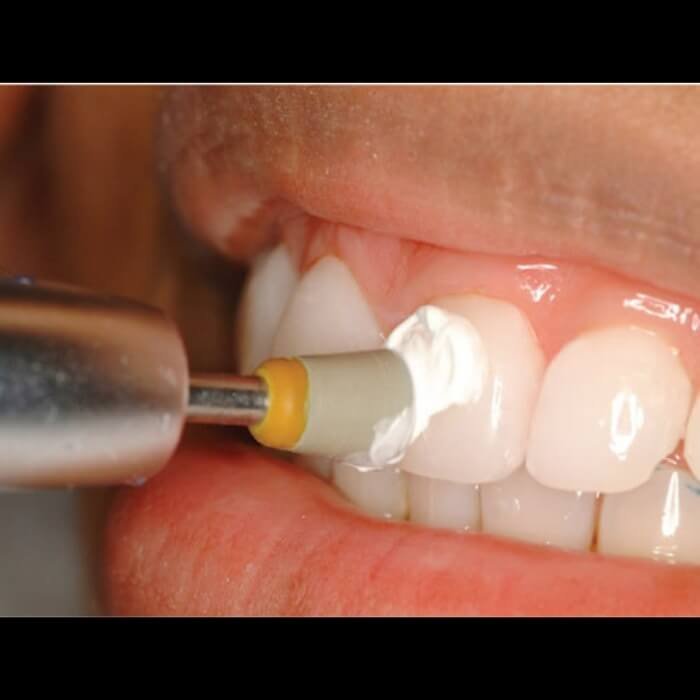 teeth-polishing-service-by-best-dentists-in-hyderabad