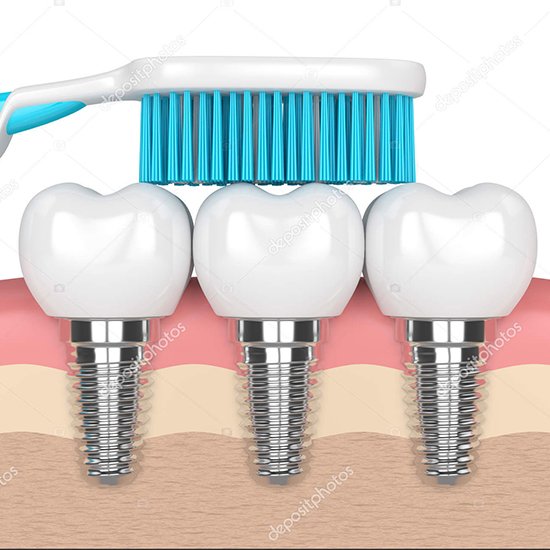Cleaning-procedure-dental-implant-placement
