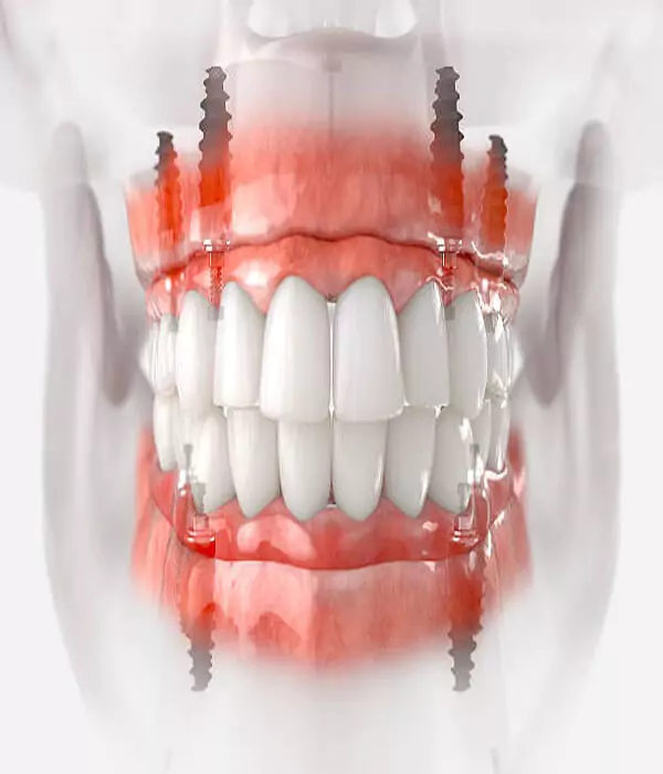 all-on-4-dental-implant-placement-at-best-dental-hospital-in-hyderabad-drjaydev