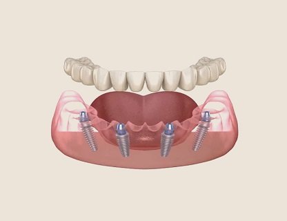 all-on-4-dental-implants-drjaydev