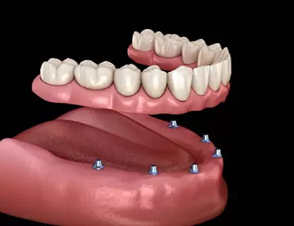 all-on-6-dental-implants-drjaydev