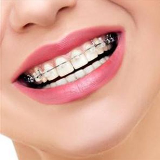 Best dental braces in Hyderabad - Dental braces near me