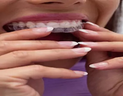 clear-aligners-treatment