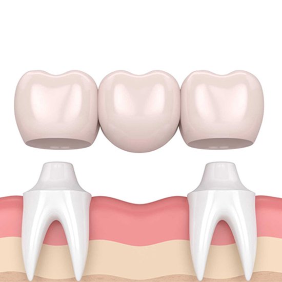 dental-bridge-placement-over-implants-in-best-dental-clinic-hyderabad