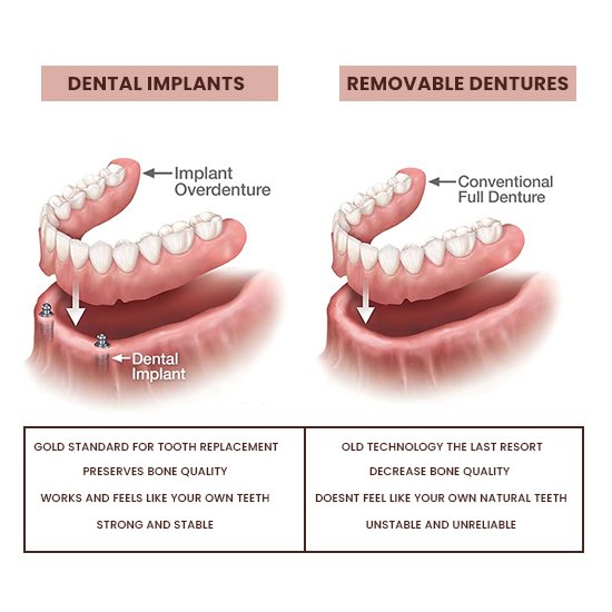 dentures-vs-dental-implants-benefits
