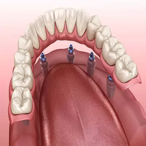 Dental-implants-treatment-procedure-in-hyderabad