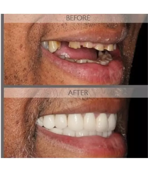 Mouth-before-and-after-full-mouth-reconstruction-procedure