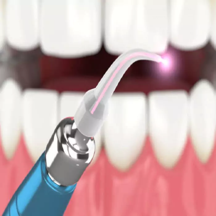 laser-dental-treatment-step-by-step-procedure-laser-dentistry