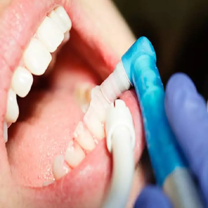 best-tooth-cleaning-dental-polishing-service-and-advantages-in-hyderabad
