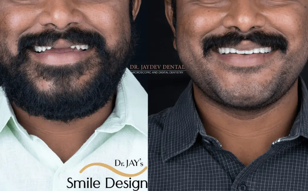 best smile designing treatement before after