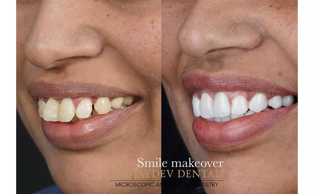 smile-before-after-smile-designing-done-at-smile-designing-clinic-in-india