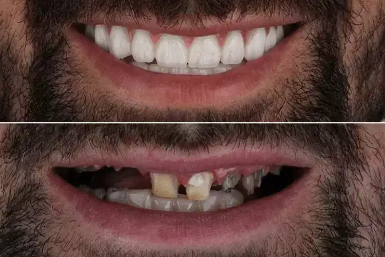 full-mouth-reconstruction-treatment-in-hyderabad