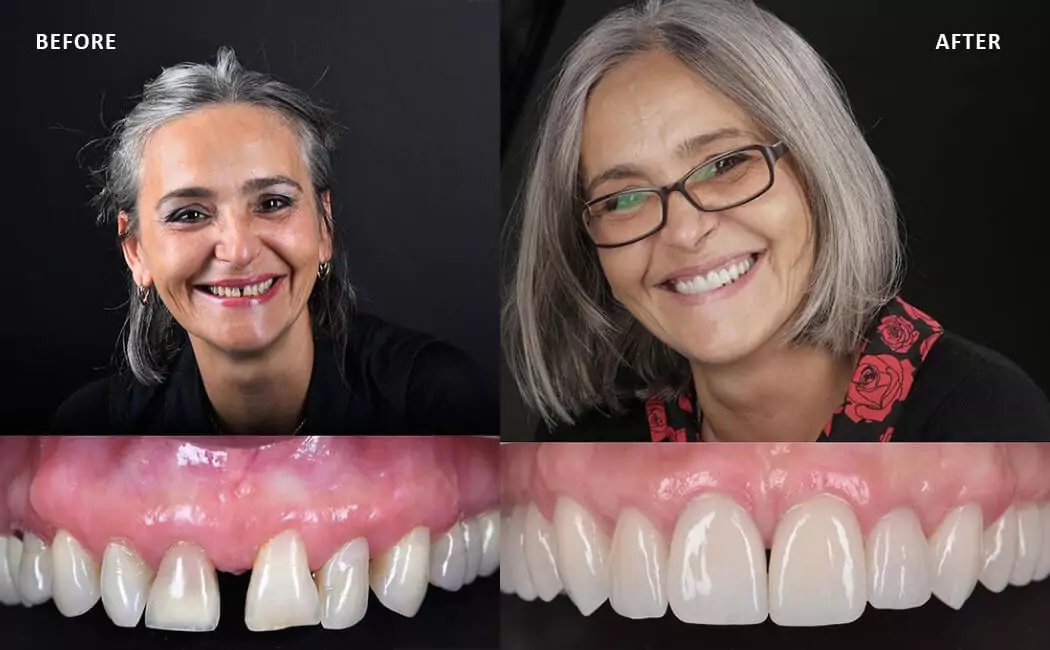 before-and-after-of-full-mouth-reconstruction-at-drjaydev-dental-clinic