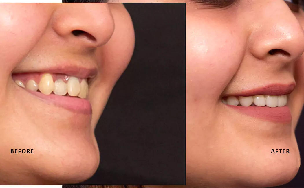 change-in-smile-before-after-smile-designing-done-at-smile-designing-clinic-in-hyderabad
