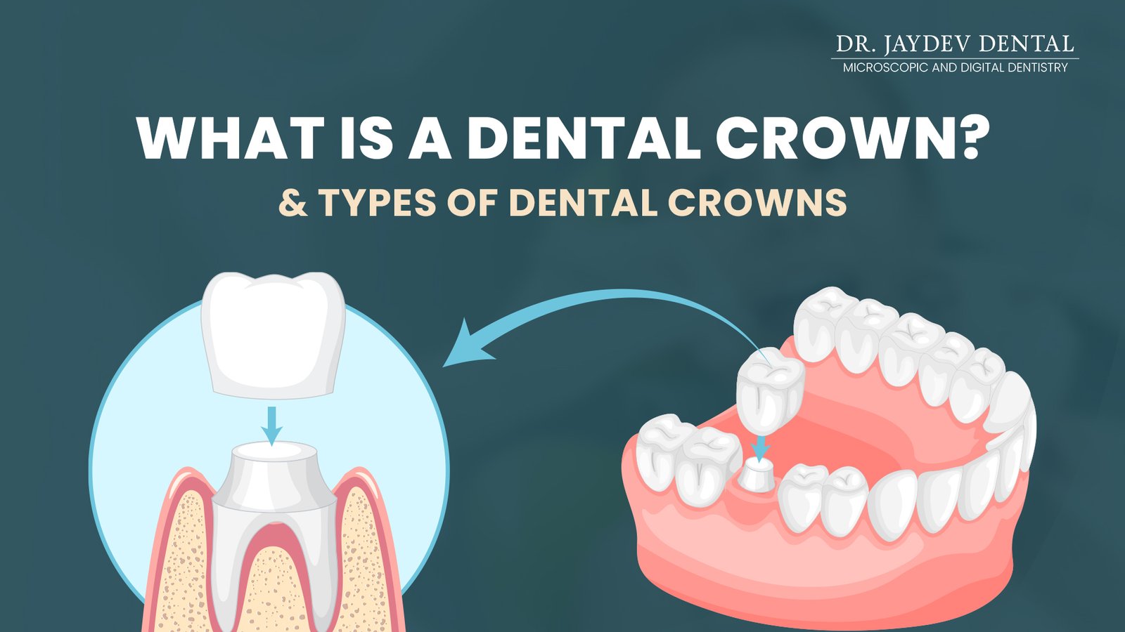 What is Dental Crown - Types of Crowns