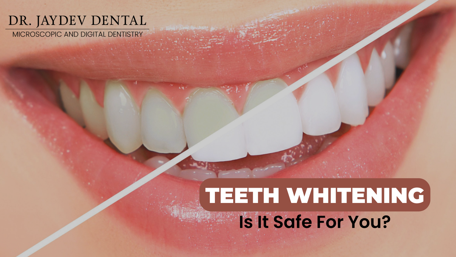 What is Teeth Whitening? - Is it safe for Oral Health