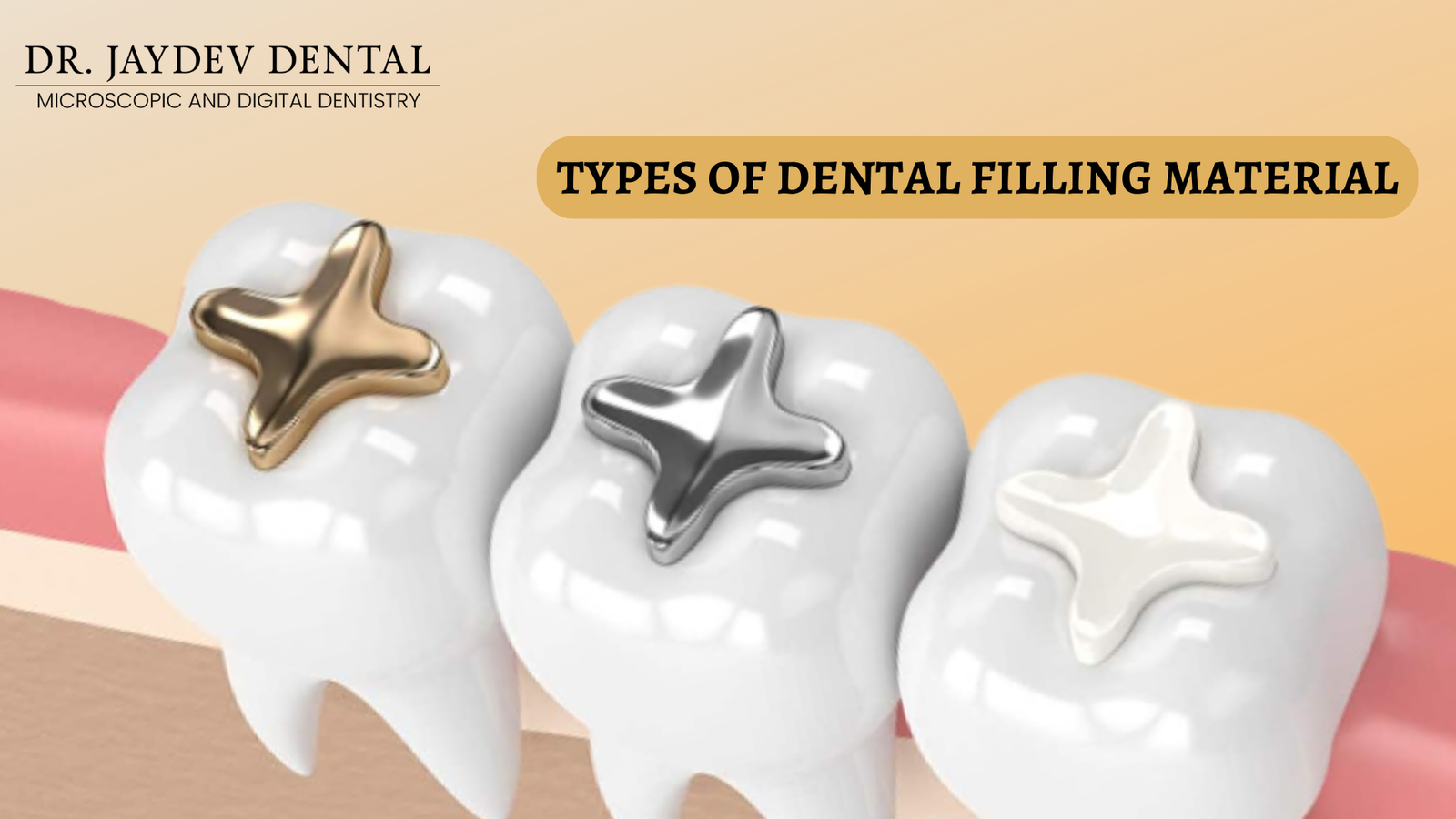 Types of Dental Filling Material & Which is the Best Filling Material