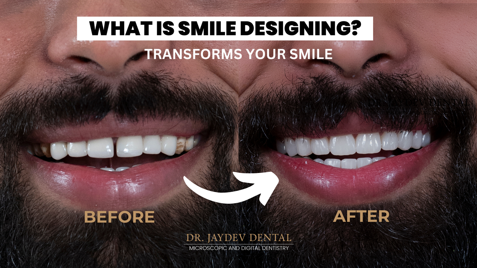 What is Smile Designing? All about Smile Designing 