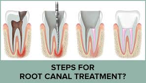 Root Canal Treatment & Causes