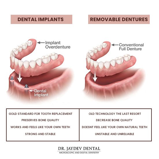 differences-dental-implants-dentures
