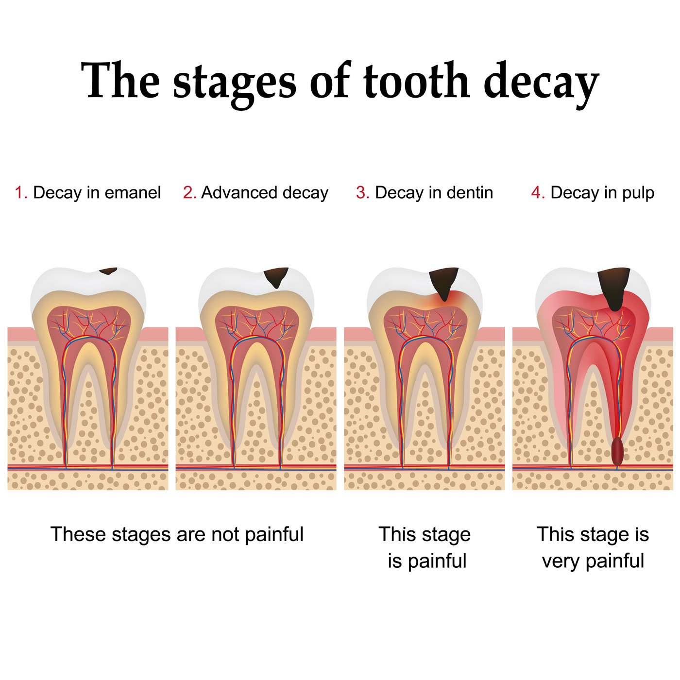 tooth-decay-stages