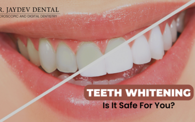 What is Teeth Whitening? – Is it safe for Oral Health