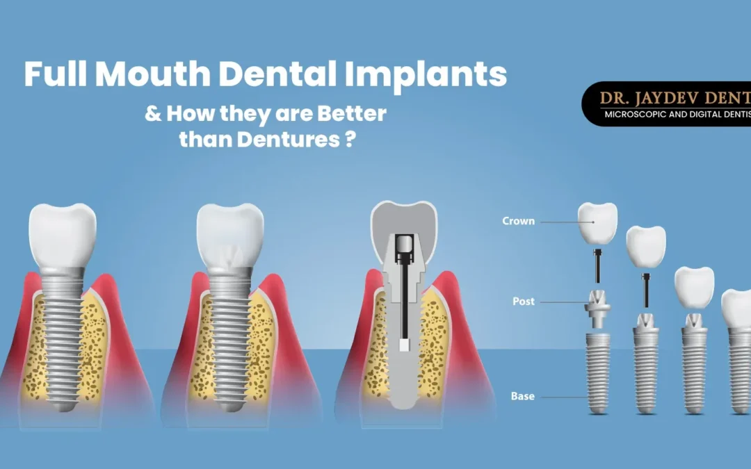 Full mouth dental implants in Hyderabad India