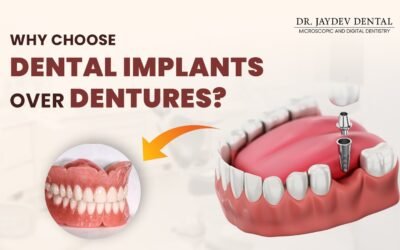 Why Choose Dental Implants over Dentures?