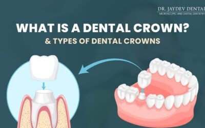 What is Dental Crown – Types of Crowns