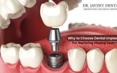 Why should one consider dental implants for replacing my missing tooth?