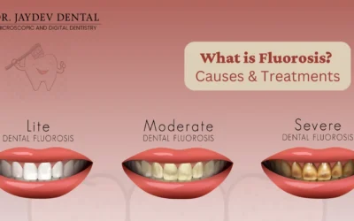 What is Fluorosis? Causes & Treatments