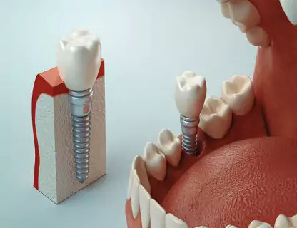 3d-guided-dental-implants