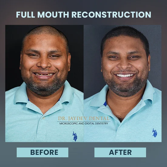 FullMouth Before-After