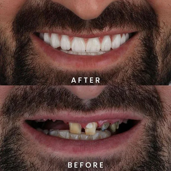 FullMouth Before and After