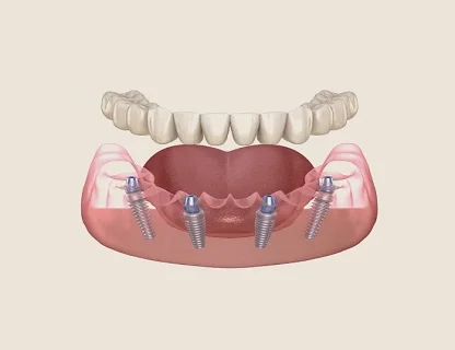 3d-guided-dental-implants