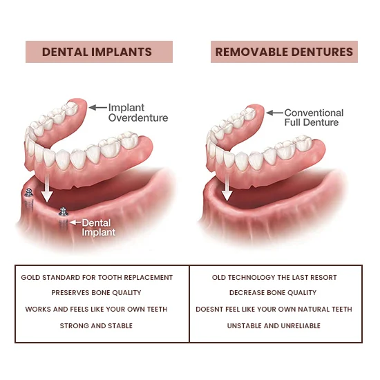 choose-dentures-or-dental-implants