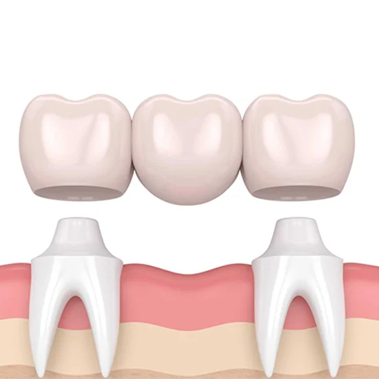 dental-bridges