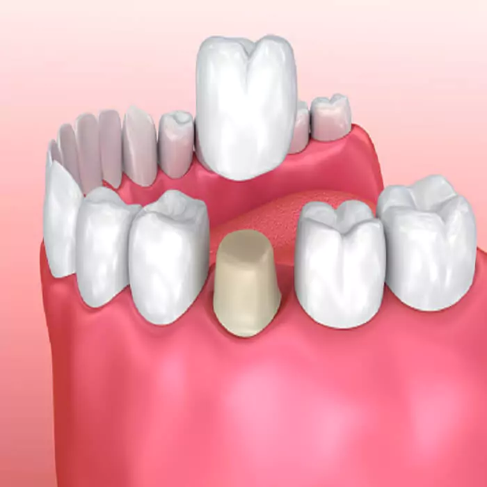 dental-crowns-treatment