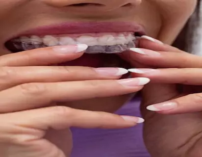 invisible aligners