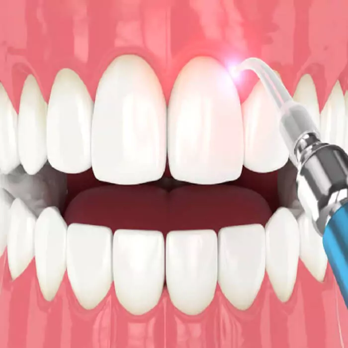 laser-dentistry-advantages