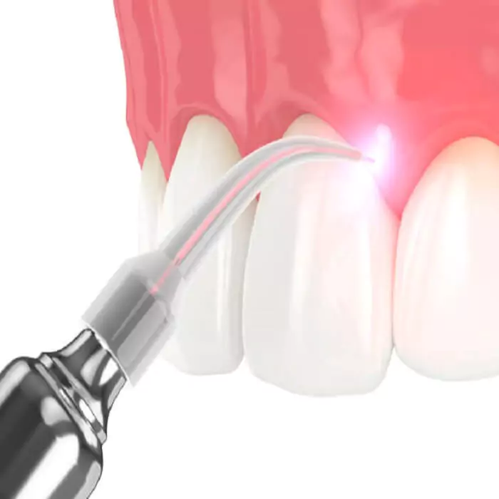 laser-dentistry-treatment