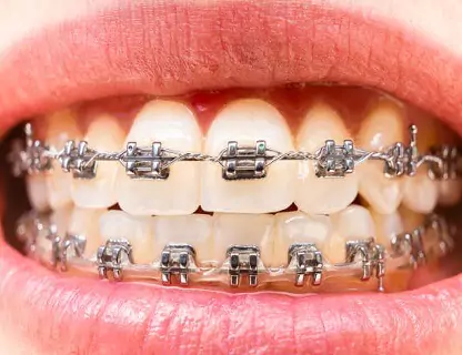 metallic braces