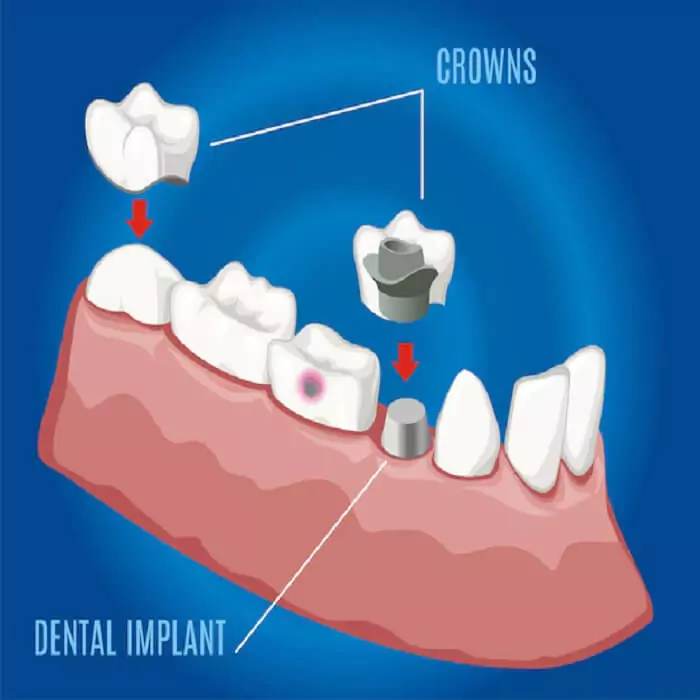 need-of-dental-crown