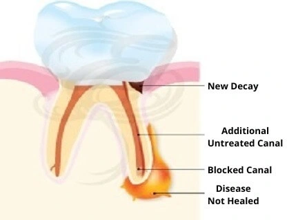 re-root-canal-issues