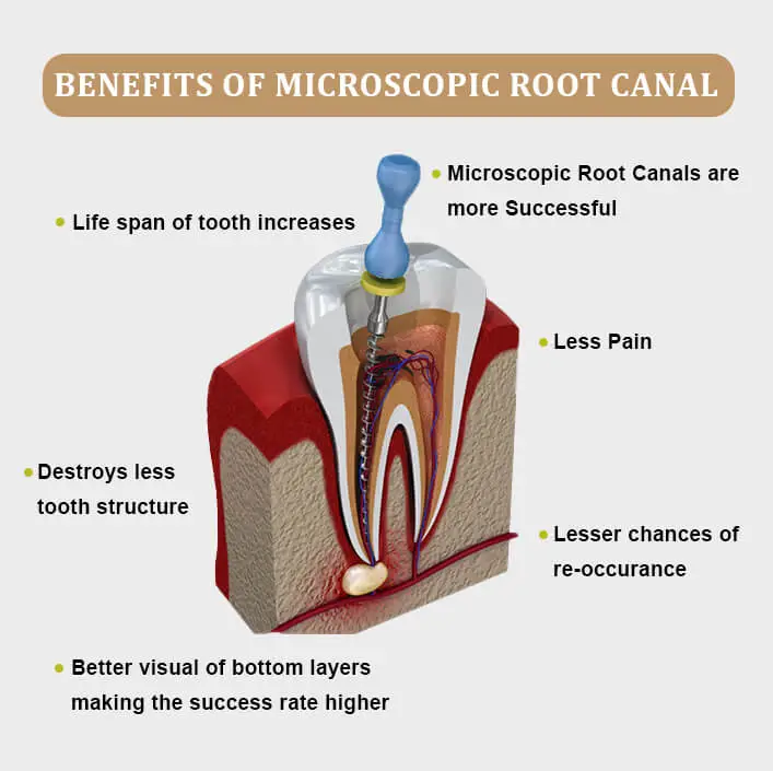 root-canal-treatment-benefits