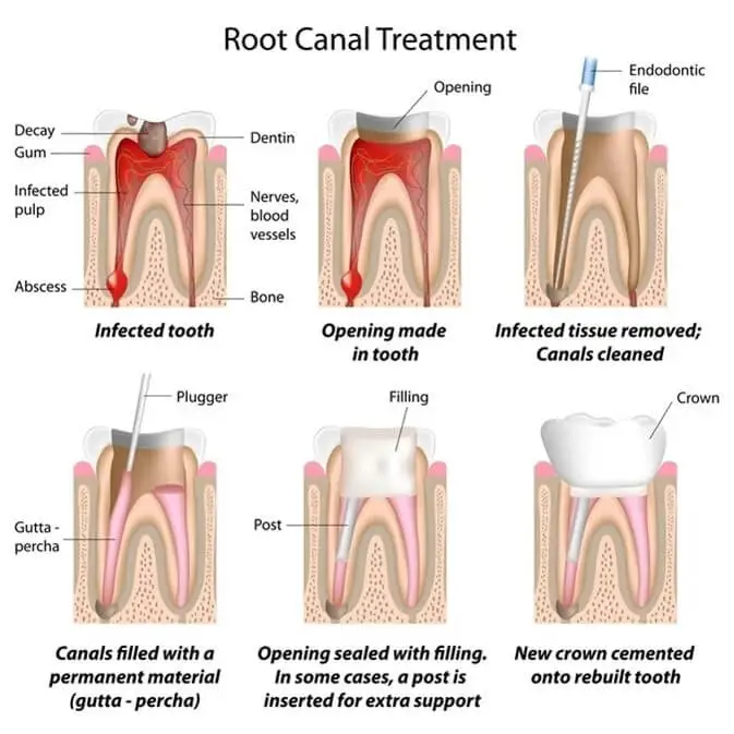 who-can-get-root-canal-treatment