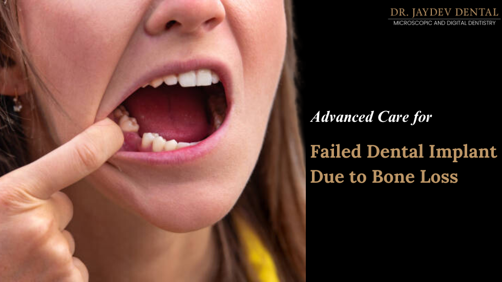 Introduction: Failed Dental Implant Due to Bone Loss