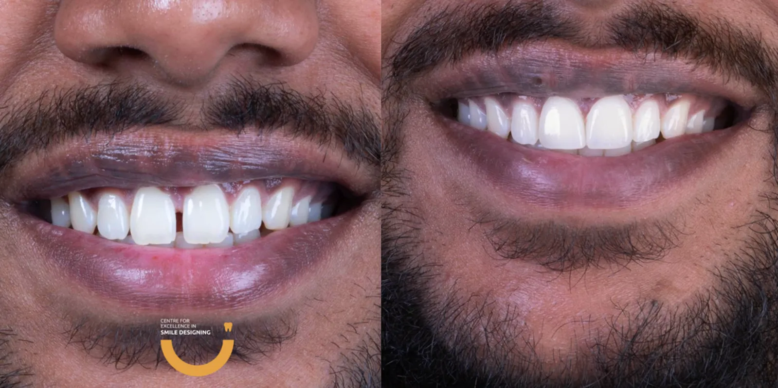 Diastema Treatment Using Dental Veneers | Jaydev Dental veneers-before-after