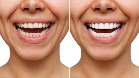 Invisalign Vs. Veneers Banner Image